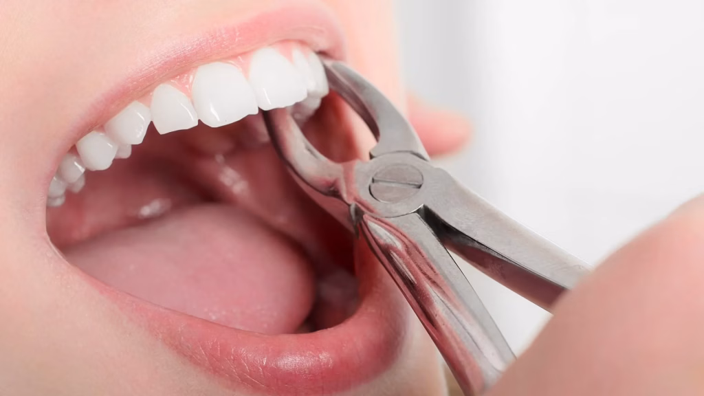 Dental extraction procedure with forceps gripping a tooth inside a patient's open mouth, emphasizing gentle care at Rosemary Dental Spa in Albuquerque, New Mexico.