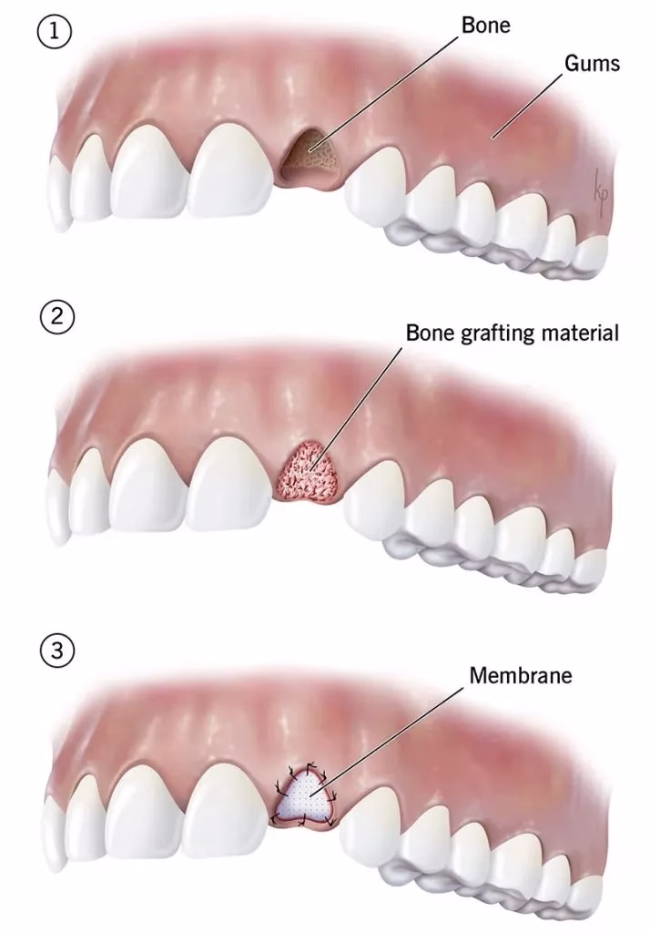 Illustration depicting the stages of a dental bone graft procedure, showing the jawbone with a defect, the placement of bone grafting material, and the application of a membrane to support healing.