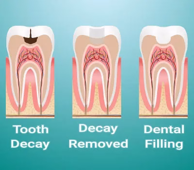 Illustration showing the progression of tooth decay: first image depicts tooth decay, second image shows decay removed, and third image illustrates dental filling restoration, highlighting the importance of tooth fillings for preserving oral health at Rosemary Dental Spa.