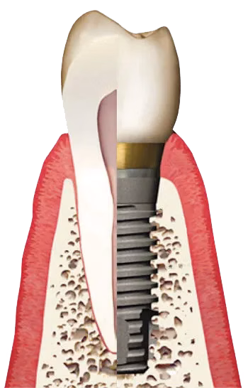 Diagram of a dental implant showing the titanium root embedded in the jawbone and topped with a natural-looking crown, illustrating the structure and function of dental implants for tooth replacement.