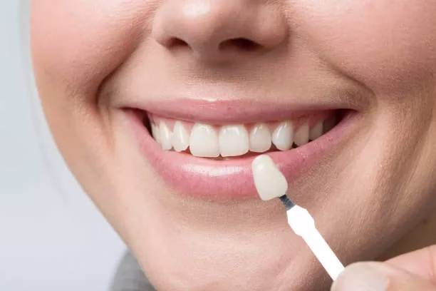 Woman smiling while a dental professional holds a custom veneer near her teeth, showcasing the smile enhancement process with CEREC technology.