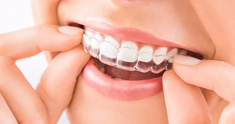 Person inserting a custom mouth guard for dental protection, highlighting oral health and comfort, relevant to custom mouth guard services at Rosemary Dental Spa in Albuquerque, New Mexico.